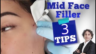 MidFace Injection 3 Tips [upl. by Marguerite]