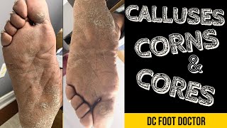 Calluses Corns and Cores [upl. by Noonan629]