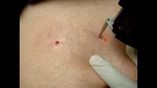 Cherry Angiomas Red Moles Treatment [upl. by Necaj]