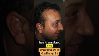 Hair transplant in Chandigarh for natural results [upl. by Ruelu141]