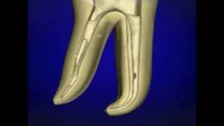 EndoActivator  устройство эндодонтическое  Dentsply Великобритания [upl. by Eetnom]