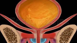 Cystometry  Animated Atlas of BPH and OAB [upl. by Beacham661]