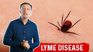 7 Weird Lyme Disease Symptoms that You Need to Know – DrBerg [upl. by Aliuqehs]