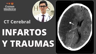 Curso de Tomografía Cerebral Simple  Infartos y Trauma Parte 2 [upl. by Aneeh217]