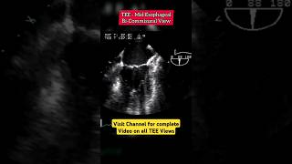 Mitral Comissural View on Transesophageal Echocardiogram echocardiography heart [upl. by Loma825]