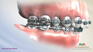 Orthodontics Treatment for Overjet Overbite  Headgear vs Forsus Appliance [upl. by Eimat]