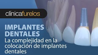 La complejidad en la colocacion de implantes dentales [upl. by Bledsoe]