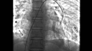 Hereditary Haemorrhagic Telangiectasia [upl. by Millar]