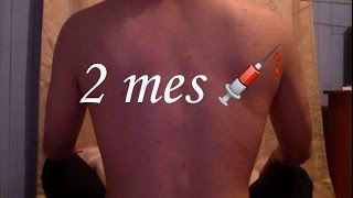 2 MES en Testosterona FTM Chile│Gabriel Sepúlveda [upl. by Jenette130]