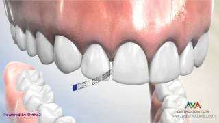 Interproximal Reduction or IPR  Polishing Strip [upl. by Bank]