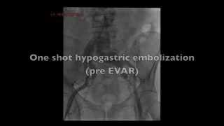 Amplatzer Plug for one shot hypogastric embolization pre EVAR [upl. by Aisanat494]