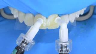 Fluorosis treatment using Icon infiltration step by step [upl. by Ronoc]