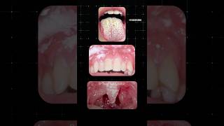 வாயில் ஏற்படும் பூஞ்சை தொற்று Oral Thrush Dr Isacc Abbas [upl. by Sibella227]