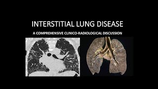 INTERSTITIAL LUNG DISEASES PART 6 SMOKING RELATED [upl. by Enyad585]