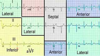 Infarto Agudo del Miocardio con Elevación del Segmento ST [upl. by Michaele]