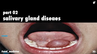 salivary gland diseases 2  oral medicine  عزت شومان [upl. by Esidnak289]