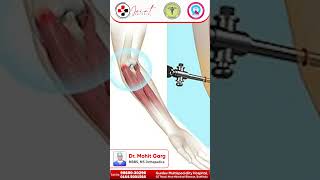 Tennis Elbow Treatment When Surgery Becomes Necessary  Dr Mohit Garg [upl. by Yeslah]