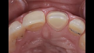 Anterior Crown Preparation [upl. by March]