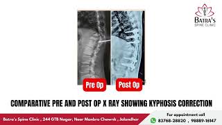 TB Spine With Paraparesis Improved After Surgery  LifeChanging Spine Surgery Success Story 13 [upl. by Tham]