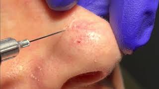 Telangiectasia Treatment on the Nose by Dr Brandon Beal [upl. by Adora]