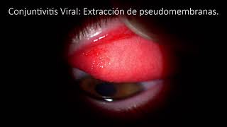 CONJUNTIVITIS  CONJUNTIVITIS PSEUDOMEMBRANOSA  CONJUNTIVITIS VIRAL [upl. by Dean]