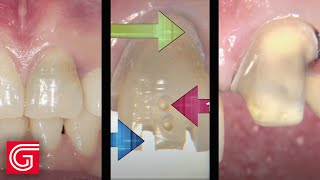 Preparing ANTERIOR Teeth for Zirconia Crowns dentalshorts [upl. by Torhert]