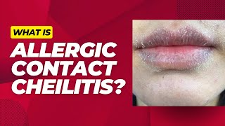 What is allergic contact cheilitis [upl. by Haldane]