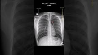 🦴📹 Anatomía radiológica de tórax [upl. by Civ356]