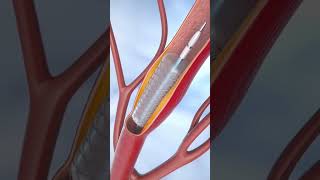 Coronary Angioplasty and stent Insertion [upl. by Nylekoorb553]