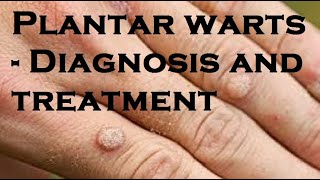 Plantar warts  Diagnosis and treatment [upl. by Arriat]