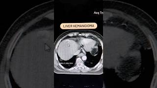 Liver Hemangioma CT abdomen shorts youtubeshorts viral [upl. by Mendez925]