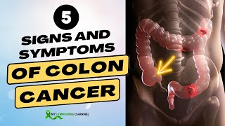 5 Signs and Symptoms of Colon Cancer [upl. by Norrehs]