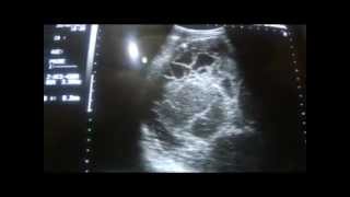 ultrasound of a RETROPERITONEAL MASS part 1a [upl. by Service]