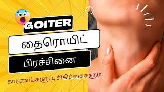 Thyroid goiter problem treatment in tamil  Thyroid problem in tamil  Thyroid treatment in tamil [upl. by Dranel958]