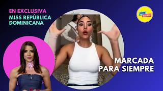 EXCLUSIVA Miss República Dominicana Sufrió Un Accidente Que La Dejará Marcada De Por Vida [upl. by Hael]