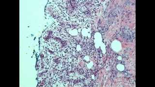 Granulation Tissue [upl. by Eniagrom]