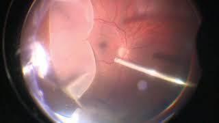 Vitrectomy for Giant Retinal Tear  Retinal Detachment  GRT  Dr Manish Nagpal [upl. by Akimak]