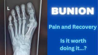 Minimally Invasive Bunion Surgery  Pain and Recovery Day by Day for the first 3 weeks [upl. by Sitoeht]