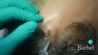 Keratoza vlasišta i uklanjanje bez oštećenja kose  Scalp keratosis procedure without hair damage [upl. by Janaya]