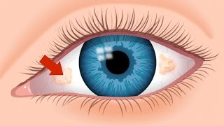 What Are The Ugly Yellow Spots In My Eye  An Optometrist Explains  True Eye Experts [upl. by Gnilhsa]