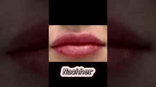 Volle amp sinnliche Lippen dank Hyaluronsäure 💋 [upl. by Eeliab]