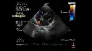 Atrial septal aneurysm with patent foramen ovalePFO [upl. by Lipfert]