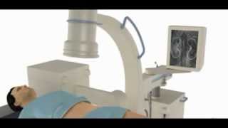 Lithotripsy for kidney stone treatment [upl. by Etteyniv]