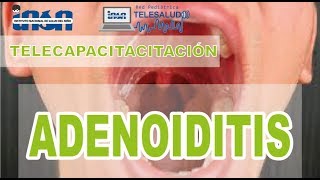 Adenoiditis  Telecapacitación INSN [upl. by Ssilb294]