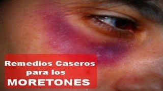 Remedios Caseros para Quitar los Moretones  Contusiones Hematomas o Golpes  Eliminar Moretones [upl. by Boleyn890]