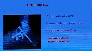 Comment aborder le pied plat valgus de lenfant [upl. by Erdnaet]