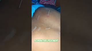 Acupuncture treatment for back pain and shoulder pain [upl. by Schinica]