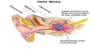 Otitis MediaMedical Surgical Nursing 2otitismedia [upl. by Anaila377]