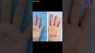 brachydactyly brachydactylytypeD 短指症手術 短指症 大拇指短粗 マムシ指 しゃもじ指 まむし指 우렁손톱 단지증 단지증수술 단지증수술후기 [upl. by Eliga696]