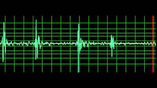 Prosthetic Mitral Valve Closing Click normal speed [upl. by Denise]